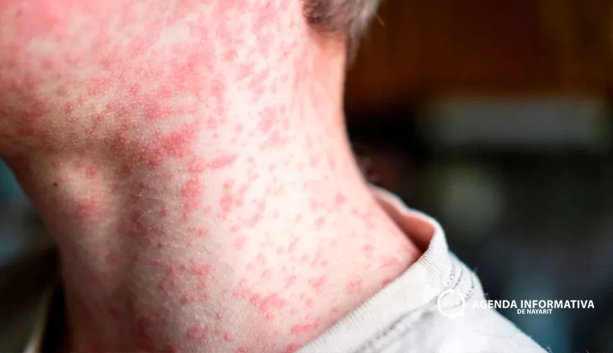 Pierde México estatus libre de sarampión; OPS lanza alerta urgente ante aumento de casos