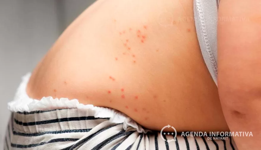 Confirman primer caso de sarampión en Bahía de Banderas; activan cerco sanitario en Nayarit