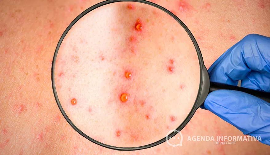 Confirma Salud federal 4 casos de sarampión en Nayarit y mantiene 81 probables bajo vigilancia