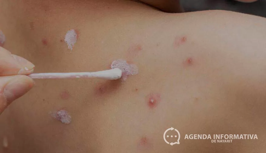 Aumentan significativamente los casos de varicela en México durante 2025