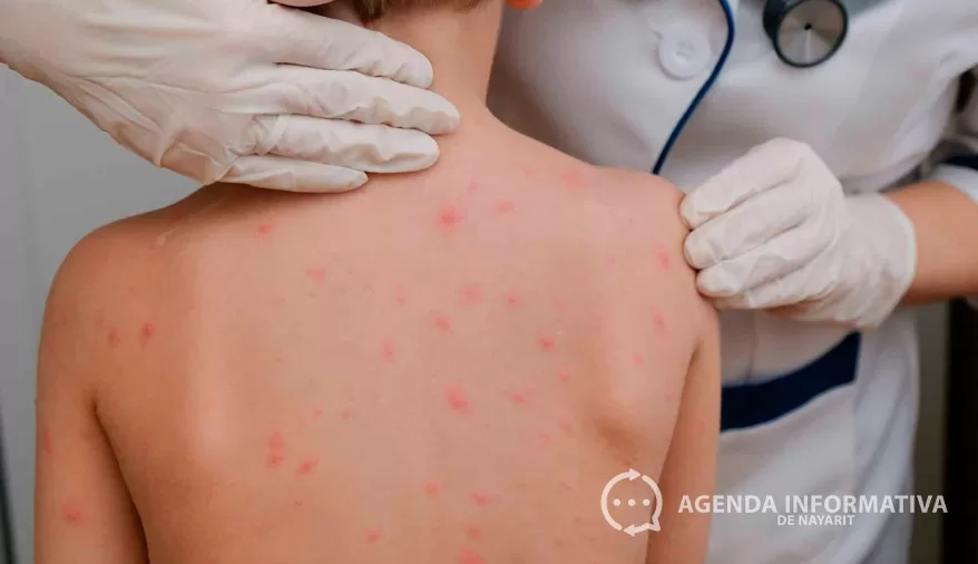 Refuerzan prevención por sarampión ante cinco casos activos en Nayarit